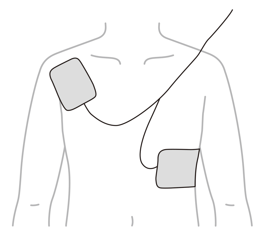 AEDの電極を貼る位置 画像